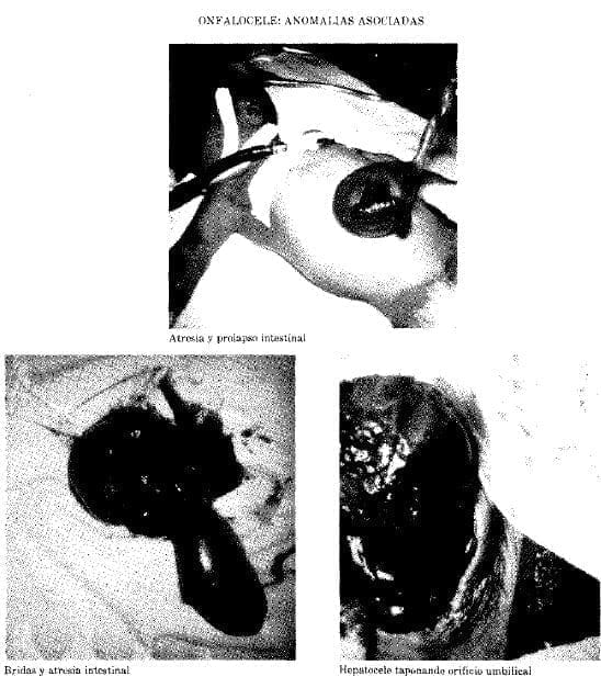 Onfalocele: Anomalías Asociadas Onfalocele: Anomalías Asociadas