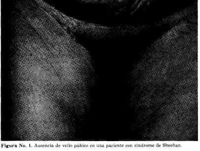 Ausencia de Vello Púbico en una paciente con Síndrome de Sheehan