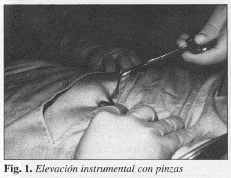 Elevación instrumental con pinzas