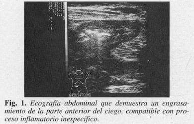 Engrasamiento de la parte anterior del Ciego