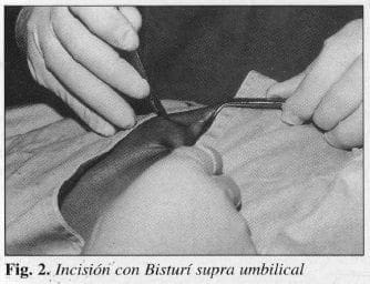Incisióri'con Bisturí supra umbilical Incisióri'con Bisturí supra umbilical