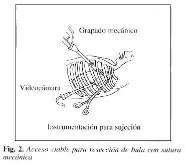 Acceso viable para resección de bula con Sutura Mecánica Acceso viable para resección de bula con Sutura Mecánica