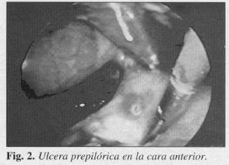 Ulcera prepilórica en la cara anterior Ulcera prepilórica en la cara anterior