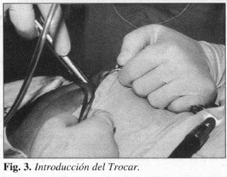 Introducción del Trocar Introducción del Trocar