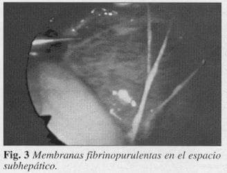 Membranas Fibrinopurulentas Membranas Fibrinopurulentas