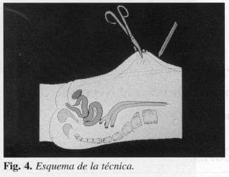 Esquema de la técnica Esquema de la técnica