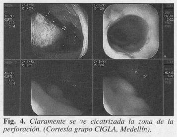 Zona de la Perforación Zona de la Perforación