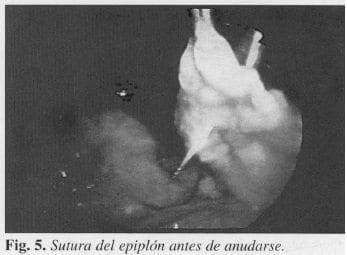 Sutura del Epiplón antes de Anudarse Sutura del Epiplón antes de Anudarse