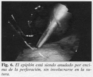 Epiplón está siendo Anudado por encima de la Perforación Epiplón está siendo Anudado por encima de la Perforación