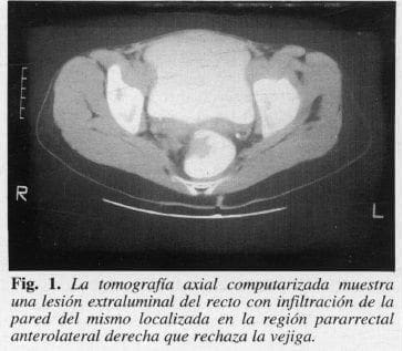 Tomografía Axial Computarizada muestra Lesión Extraluminal del Recto
