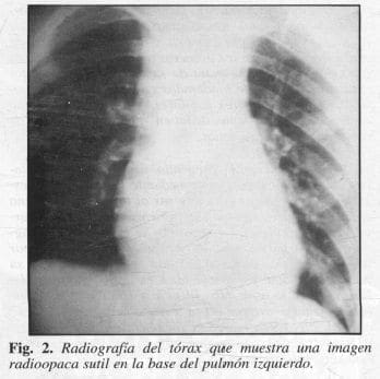 Imagen radio opaca sutil en la Base del Pulmón Izquierdo Imagen radio opaca sutil en la Base del Pulmón Izquierdo