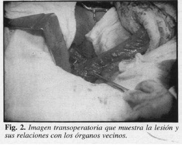 Lesión Extraluminal, relaciones con los órganos vecinos