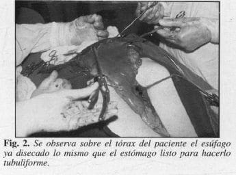 Paciente el Esófago ya disecado