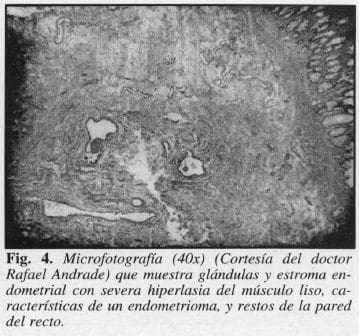 Glándulas y Estroma Endometrial con severa Hiperlasia del Músculo Liso