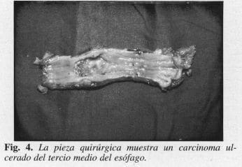 Carcinoma Ulcerado del Tercio medio del Esófago