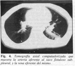 Arteria Aferente al saco Fistuloso Subpleural Arteria Aferente al saco Fistuloso Subpleural