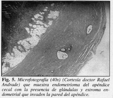 Endometrioma del Apéndice Cecal