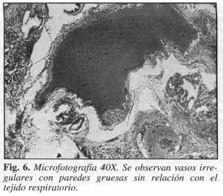 Se Observan vasos irregulares con paredes Gruesas Se Observan vasos irregulares con paredes Gruesas