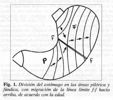 División del Estómago