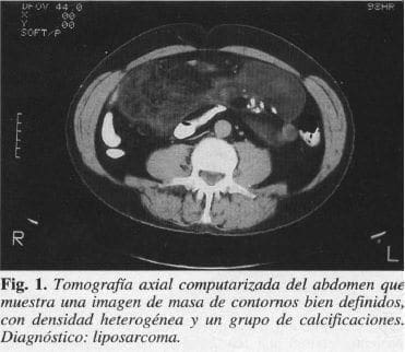 Masa de Contornos bien definidos, con Densidad Heterogénea