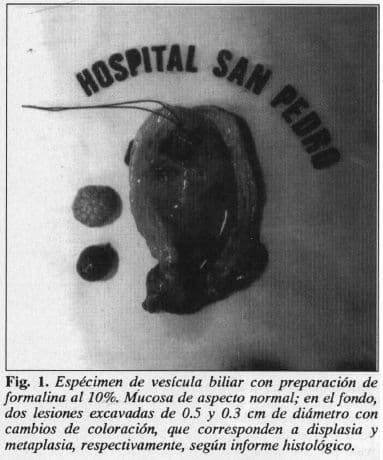 Espécimen de Vesícula Biliar