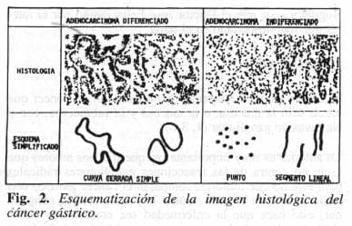 Esquematización Cáncer Gástrico Esquematización Cáncer Gástrico