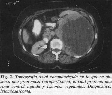 Masa Retroperitoneal, la cual presenta una Zona Central Líquida  Masa Retroperitoneal, la cual presenta una Zona Central Líquida