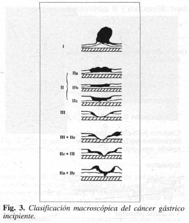 Cáncer Gástrico Incipiente Cáncer Gástrico Incipiente