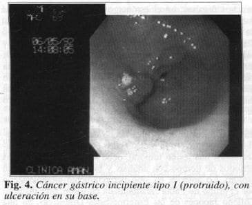 Cáncer Gástrico Incipiente tipo I