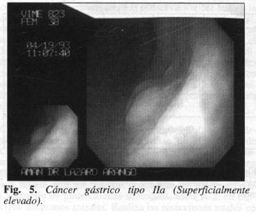 Cáncer Gástrico tipo lIa Cáncer Gástrico tipo lIa