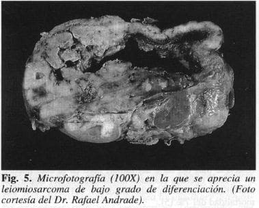 Leiomiosarcoma de bajo grado de diferenciación Leiomiosarcoma de bajo grado de diferenciación