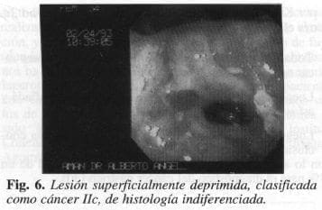 Lesión Superficialmente Deprimida Lesión Superficialmente Deprimida