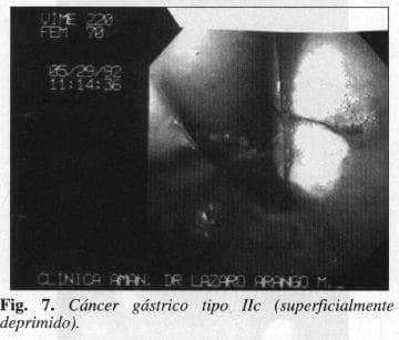Cáncer gástrico tipo lIc Cáncer gástrico tipo lIc