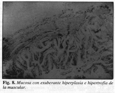 Exuberante Hiperplasia e Hipertrofia de la Muscular
