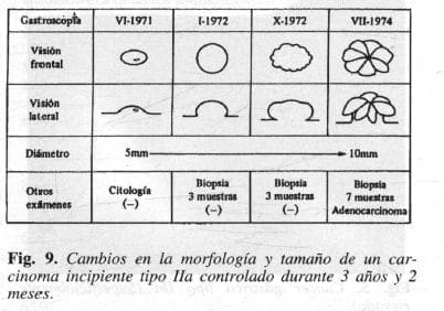 Carcinoma Incipiente tipo Ila Carcinoma Incipiente tipo Ila