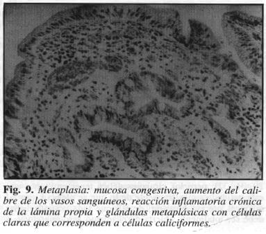 Metaplasia: Mucosa Congestiva