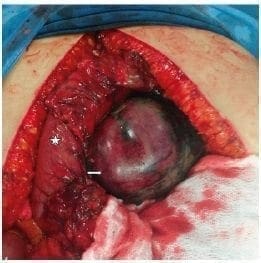 Colon ascendente necrosado