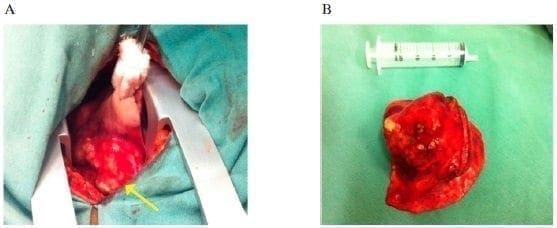 Lesión intrapulmonar