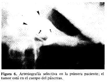 El Tumor está en el cuerpo del Páncreas El Tumor está en el cuerpo del Páncreas