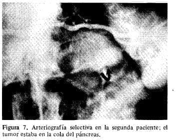 El Tumor estaba en la cola del Páncreas El Tumor estaba en la cola del Páncreas