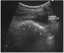 Estómago con engrosamiento parietal