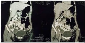 Ecografía pélvica transvaginal