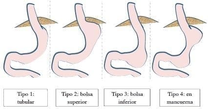Remanente gástrico en manga gástrica por laparoscopia