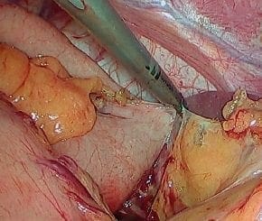 Disección y corte de los vasos gástricos