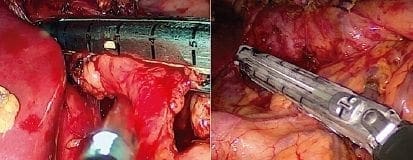 Movilización gástrica