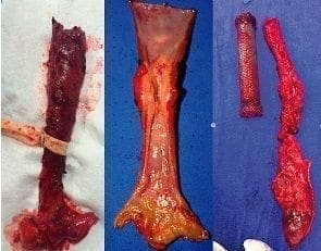 Resección esofágica