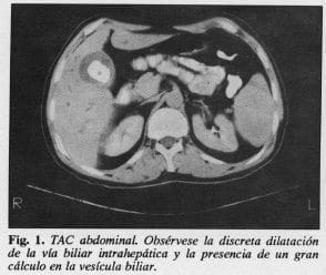 Cálculo en la vesícula biliar