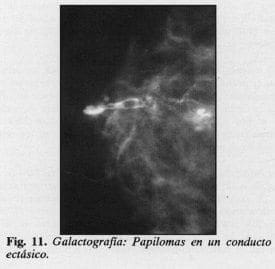 Galactografia: Papilomas en un conducto eclásico Galactografia: Papilomas en un conducto eclásico