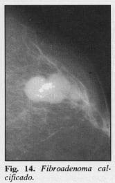 Fibroadenoma calcificado Fibroadenoma calcificado