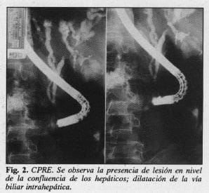 Dilatación de la vía biliar intrahepática